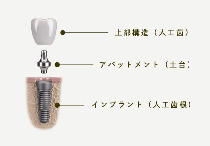 上部構造（人工歯）/アバットメント（土台）/インプラント（人工歯根）