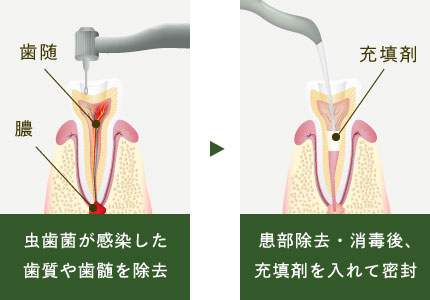 虫歯菌が感染した歯質や歯髄を除去、患部除去・消毒後、充填剤を入れて密封